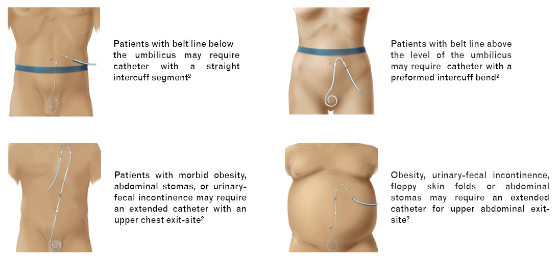 Catheter Type